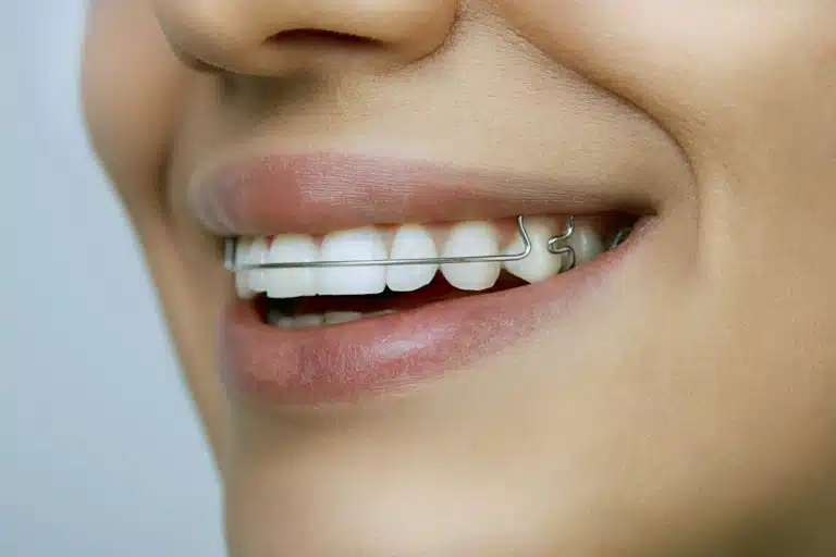 retainers 2
